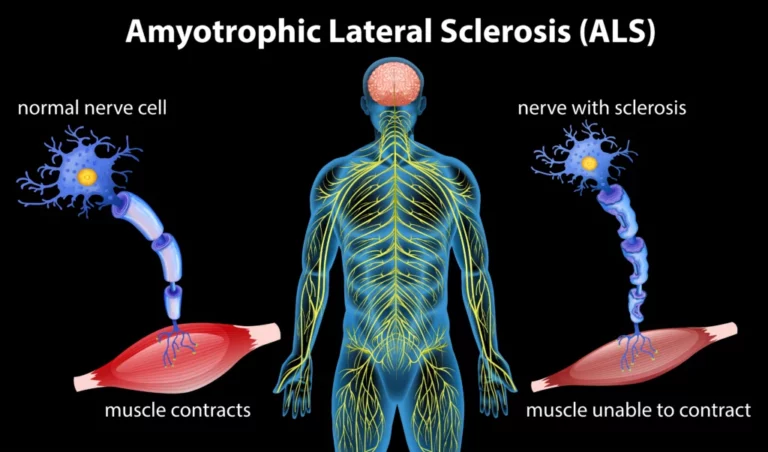 Первичный латеральный склероз и синдром Кеннеди: два заболевания двигательных нейронов