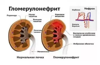 Гломерулярная болезнь почек (гломерулопатия или гломерулонефрит) — симптомы и лечение